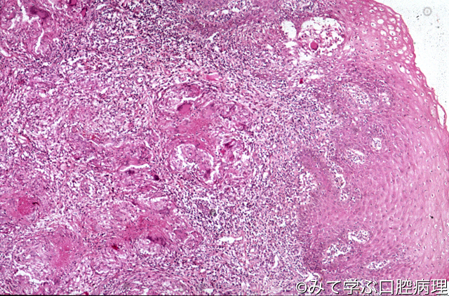 第5章 口腔粘膜の病変 口腔結核症2/5