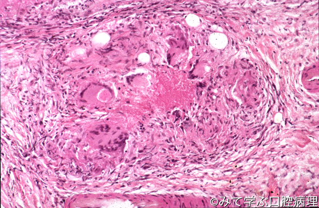 第5章 口腔粘膜の病変 口腔結核症3/5